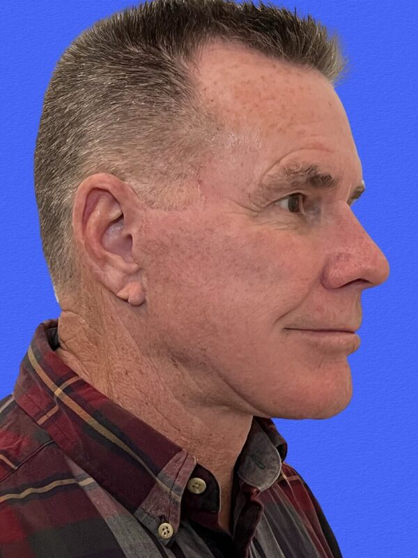 Male Facelift Before & After Image