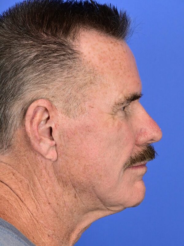 Male Facelift Before & After Image