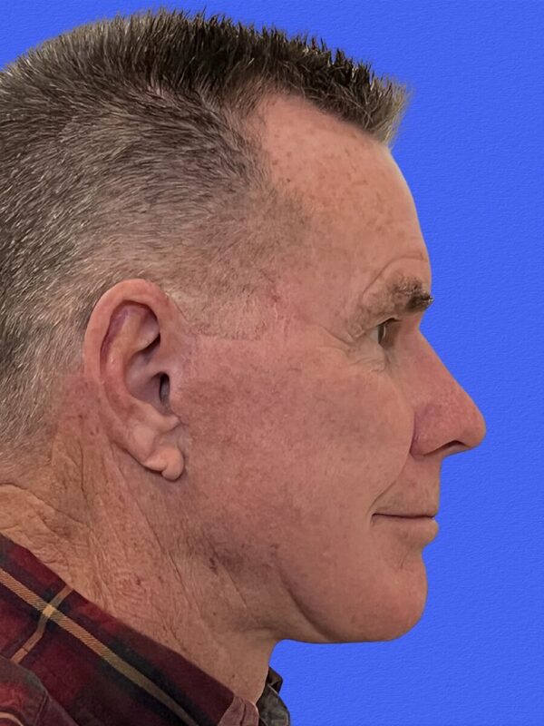 Male Facelift Before & After Image