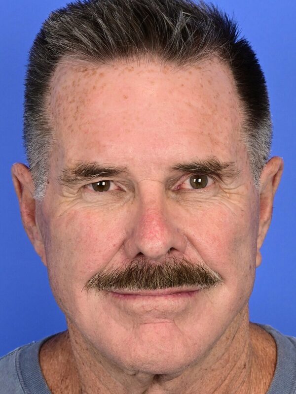 Male Facelift Before & After Image