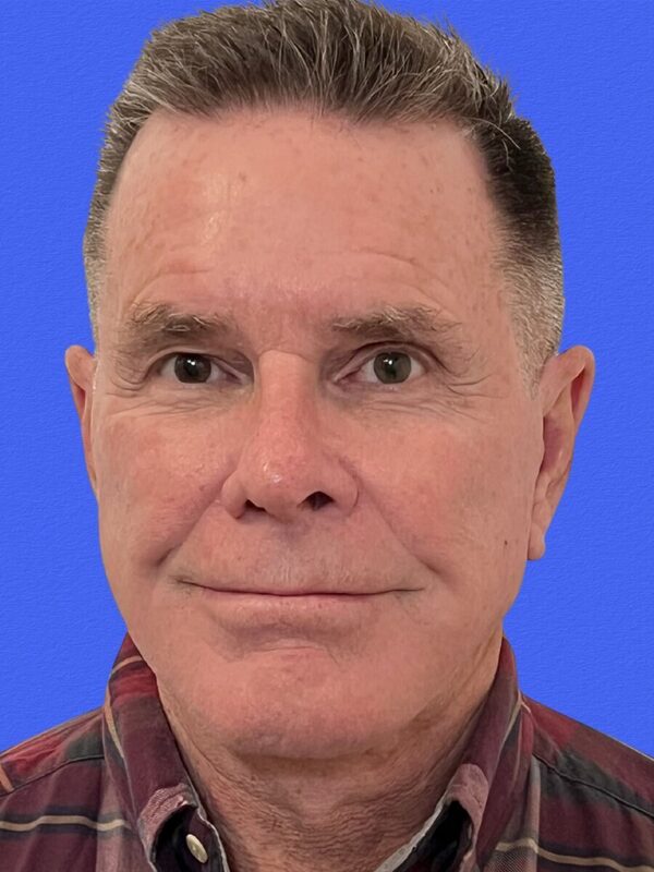 Male Facelift Before & After Image