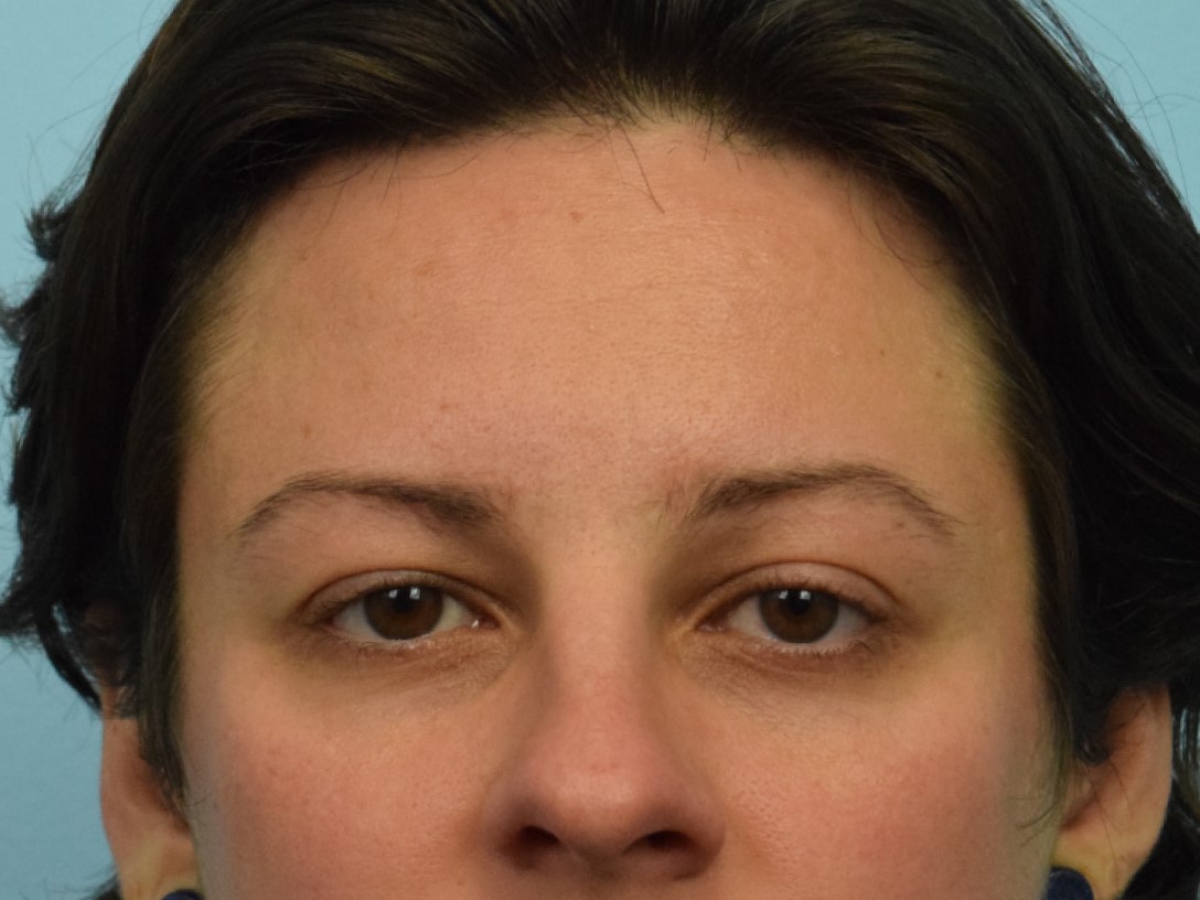 Brow Bossing Implant Before & After Image