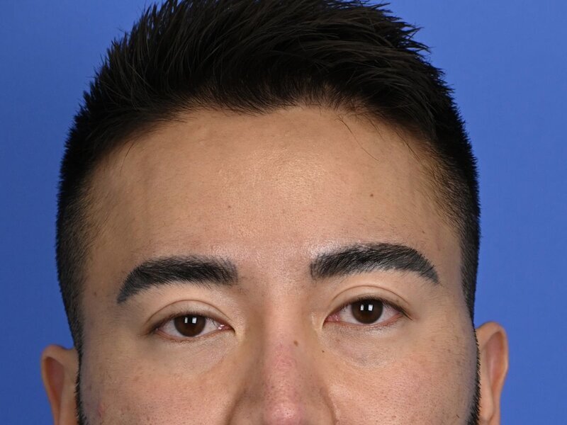 Brow Bossing Implant Before & After Image