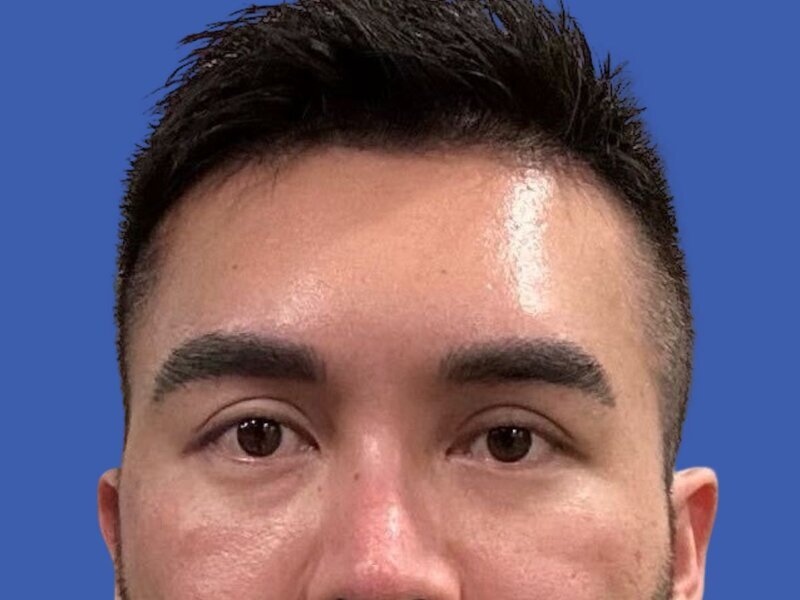 Brow Bossing Implant Before & After Image