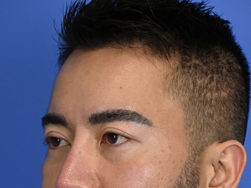 Brow Bossing Implant Before & After Image