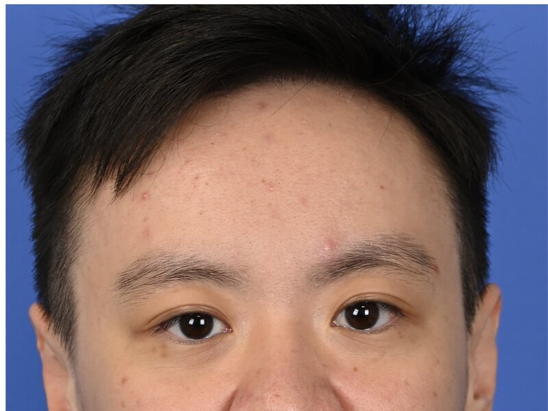 Brow Bossing Implant Before & After Image