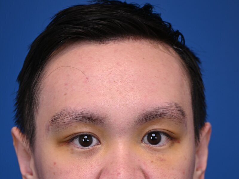 Brow Bossing Implant Before & After Image