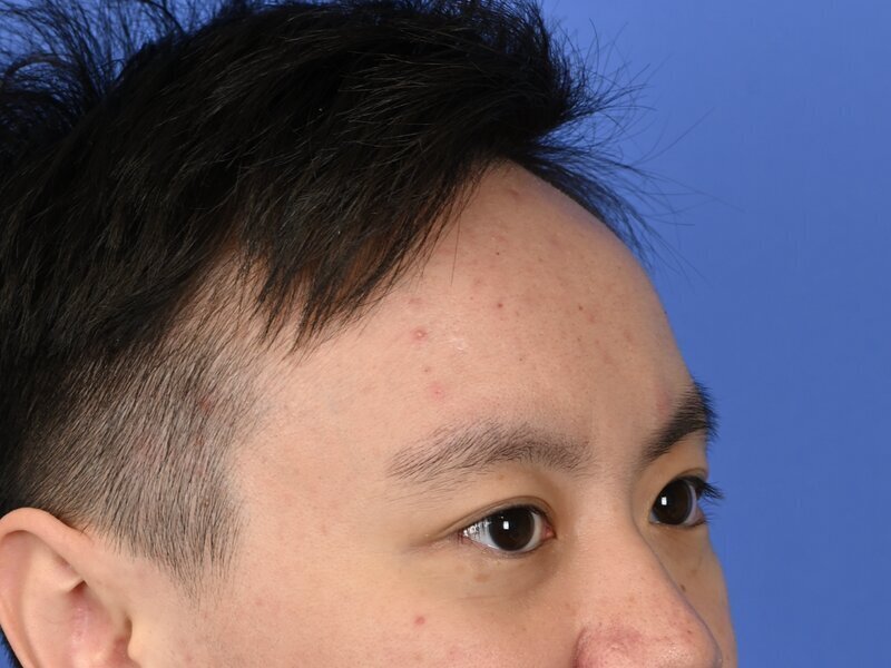 Brow Bossing Implant Before & After Image