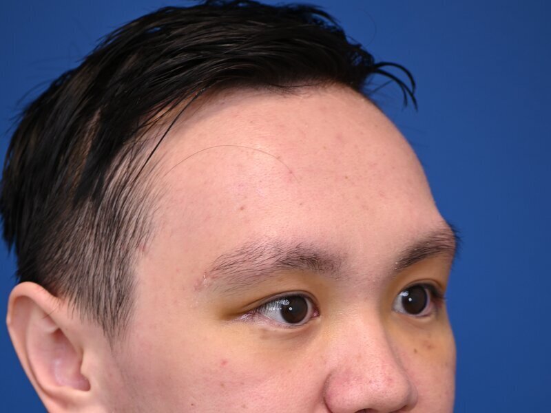 Brow Bossing Implant Before & After Image