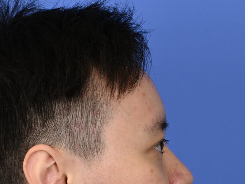 Brow Bossing Implant Before & After Image