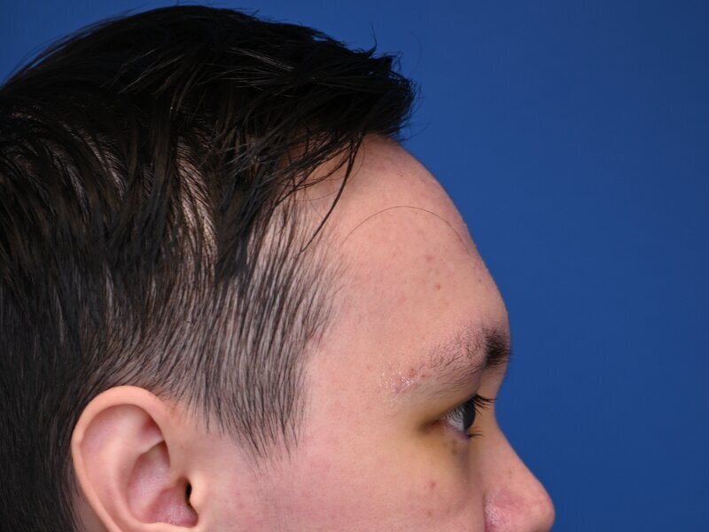 Brow Bossing Implant Before & After Image