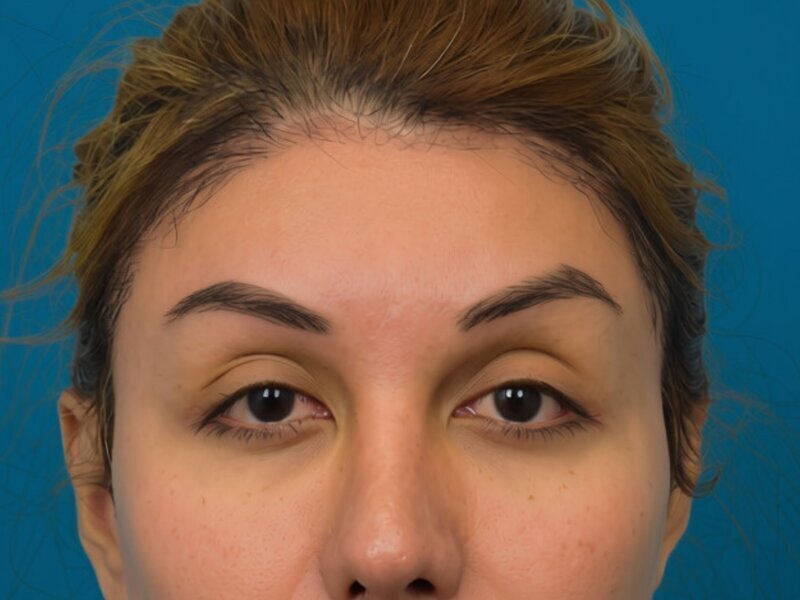 Brow Bossing Implant Before & After Image