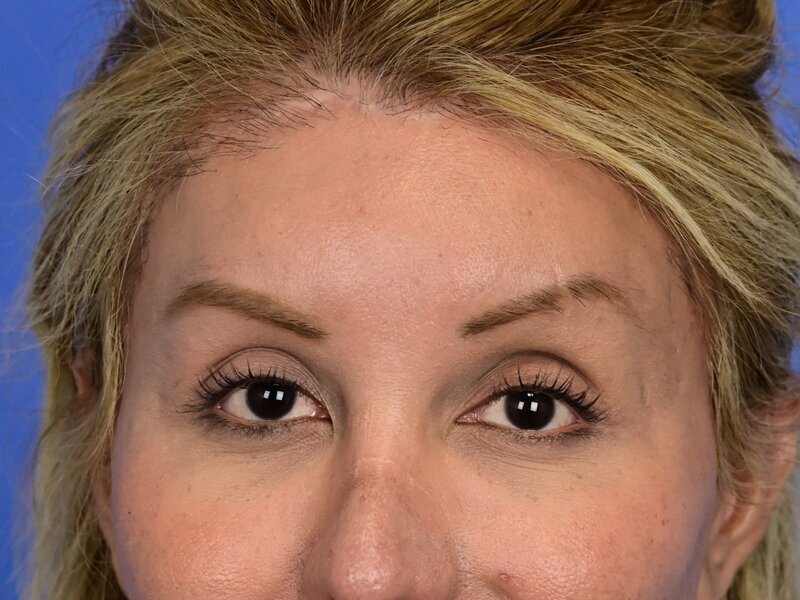 Brow Bossing Implant Before & After Image
