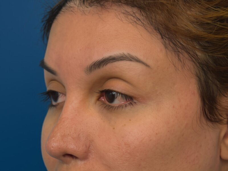 Brow Bossing Implant Before & After Image