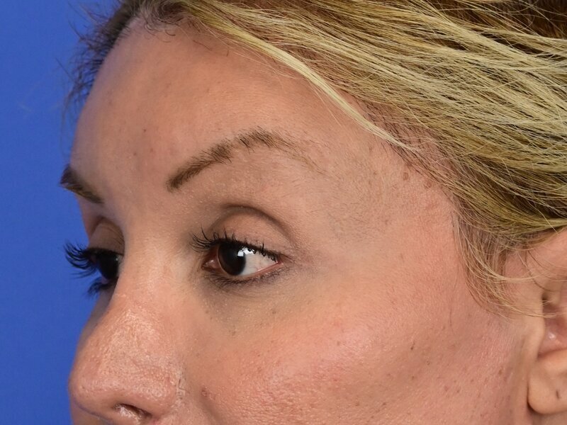 Brow Bossing Implant Before & After Image