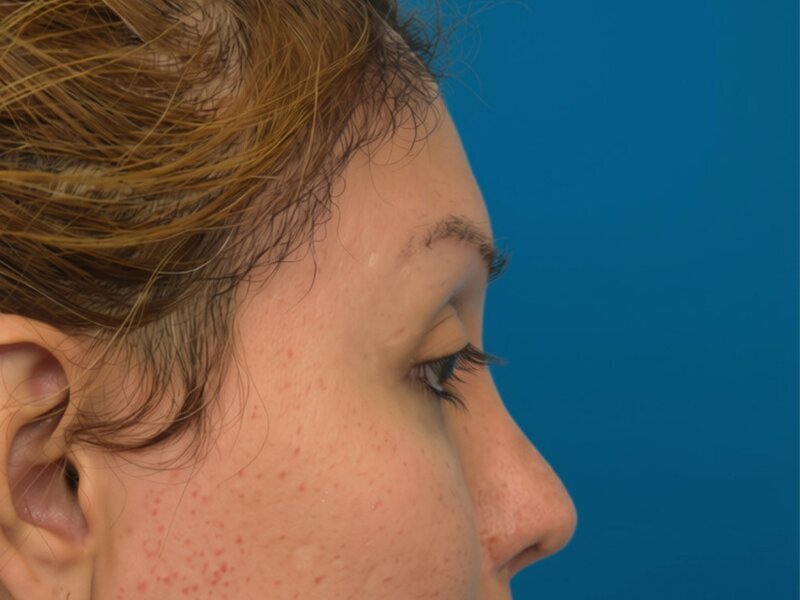 Brow Bossing Implant Before & After Image