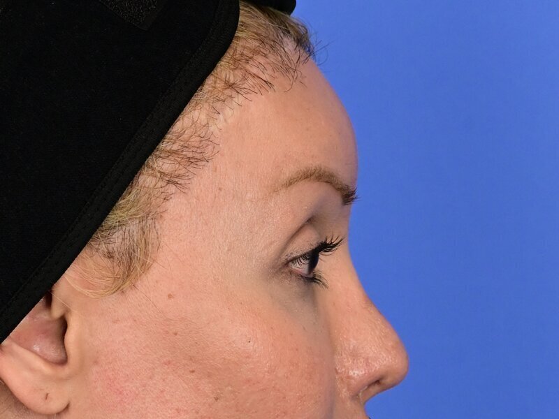 Brow Bossing Implant Before & After Image