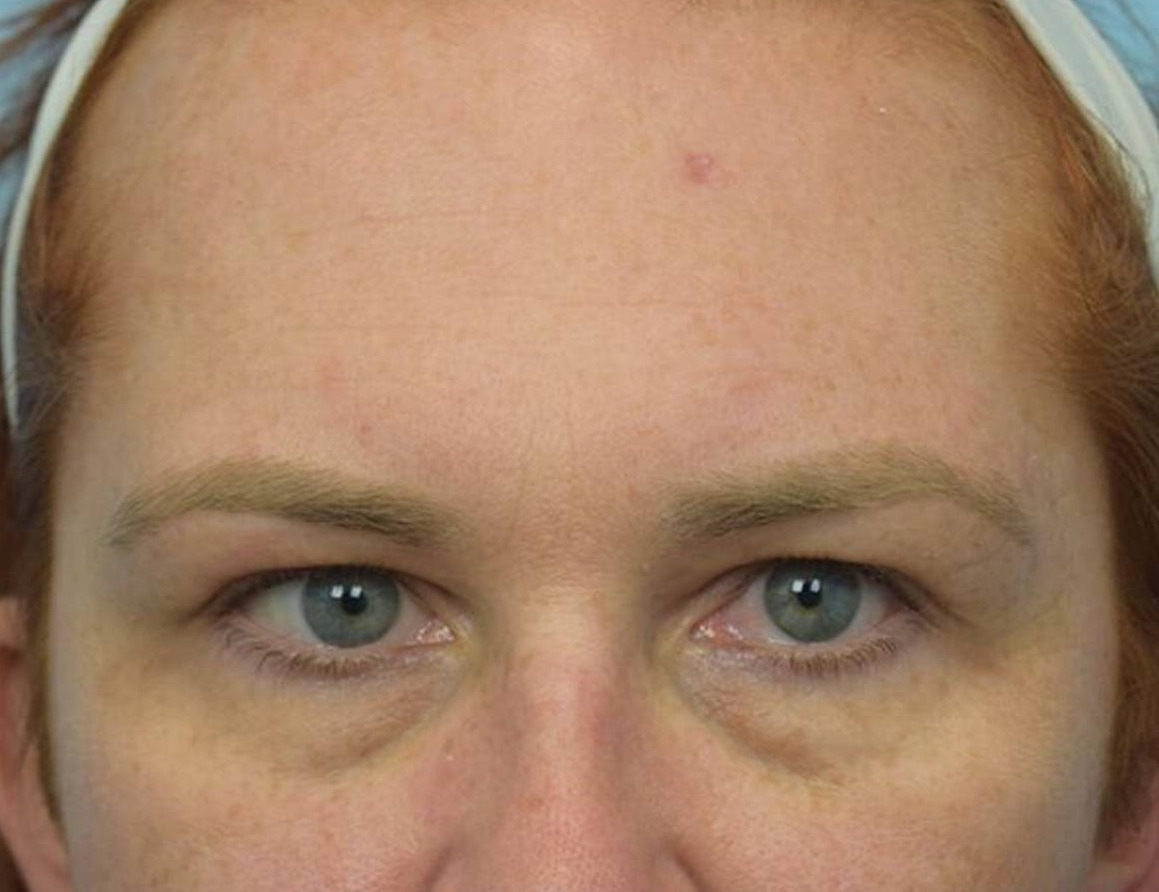 Brow Bossing Reduction Before & After Image