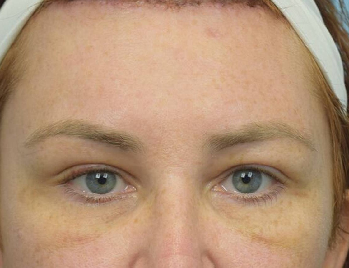 Brow Bossing Reduction Before & After Image