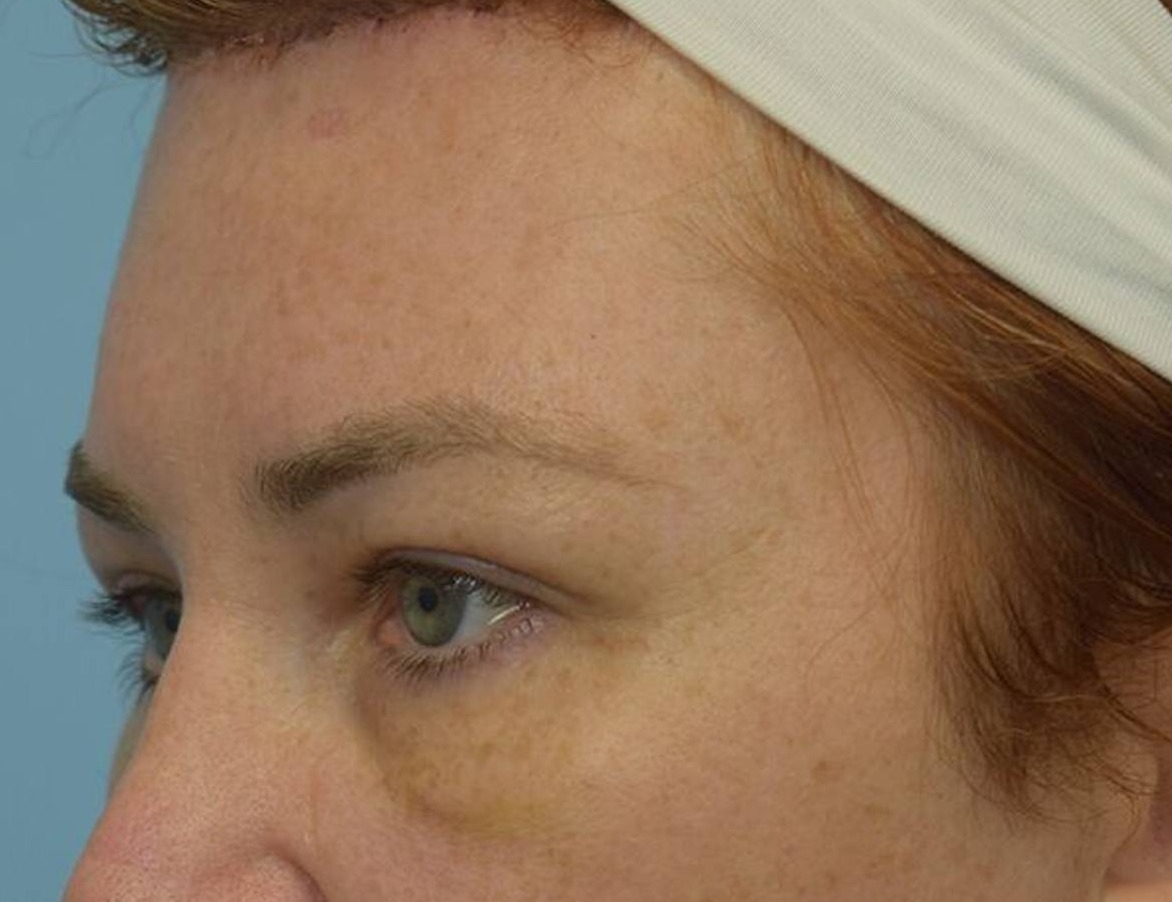 Brow Bossing Reduction Before & After Image