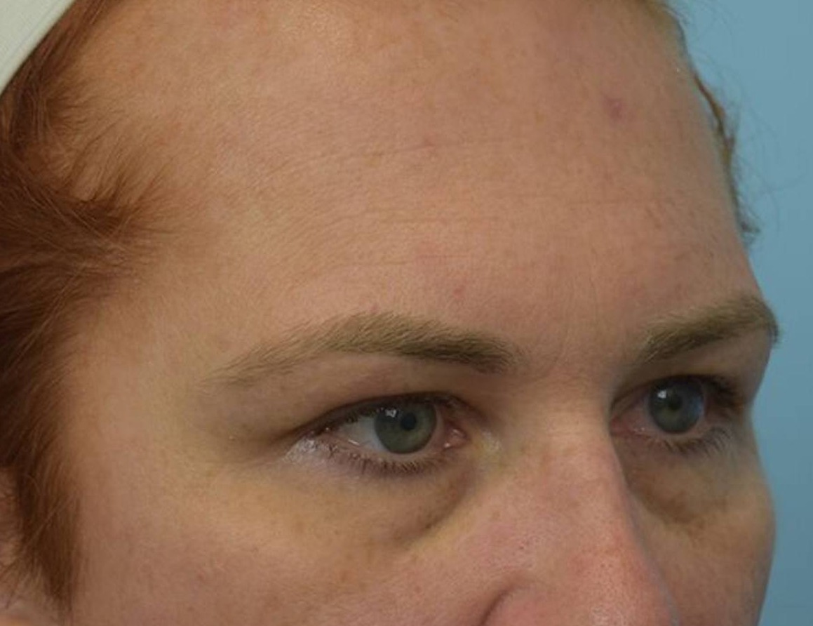 Brow Bossing Reduction Before & After Image