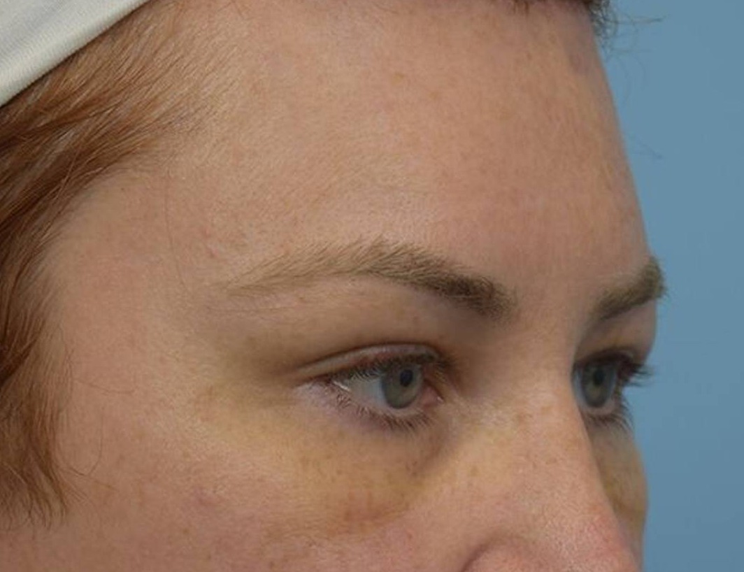 Brow Bossing Reduction Before & After Image