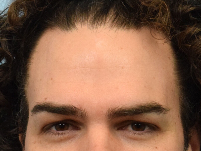 Brow Bossing Reduction Before & After Image