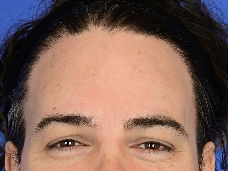 Brow Bossing Reduction Before & After Image