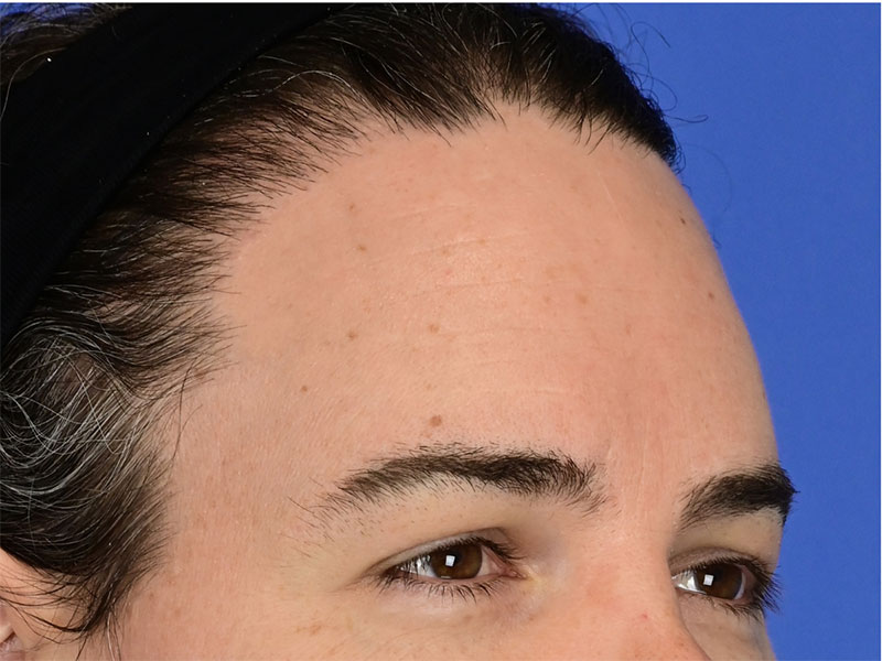 Brow Bossing Reduction Before & After Image