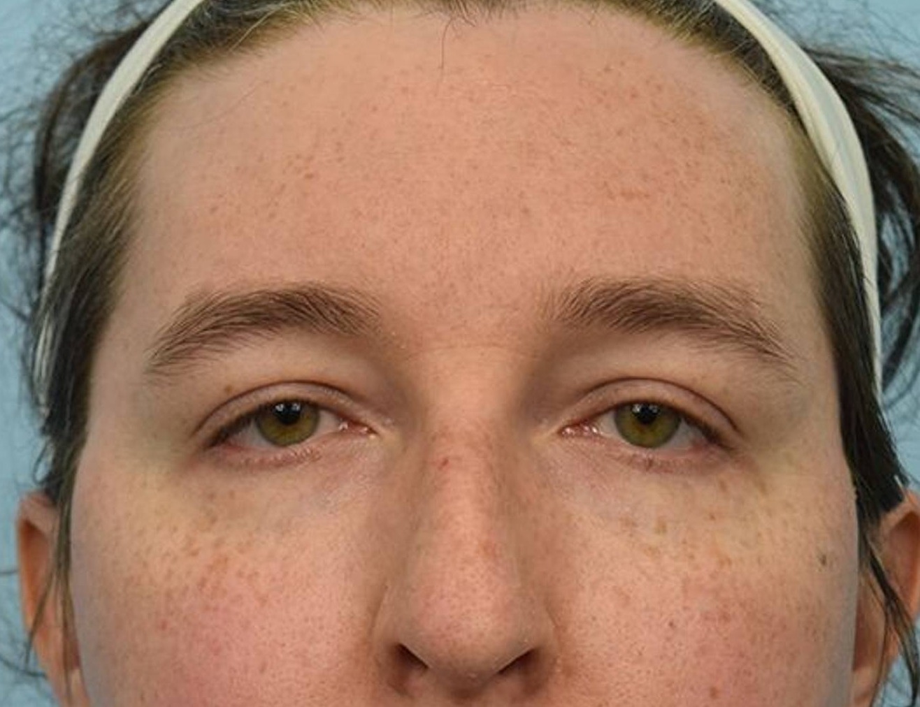 Brow Bossing Reduction Before & After Image