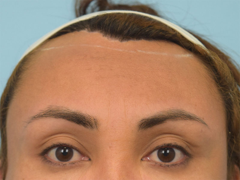 Brow Bossing Reduction Before & After Image