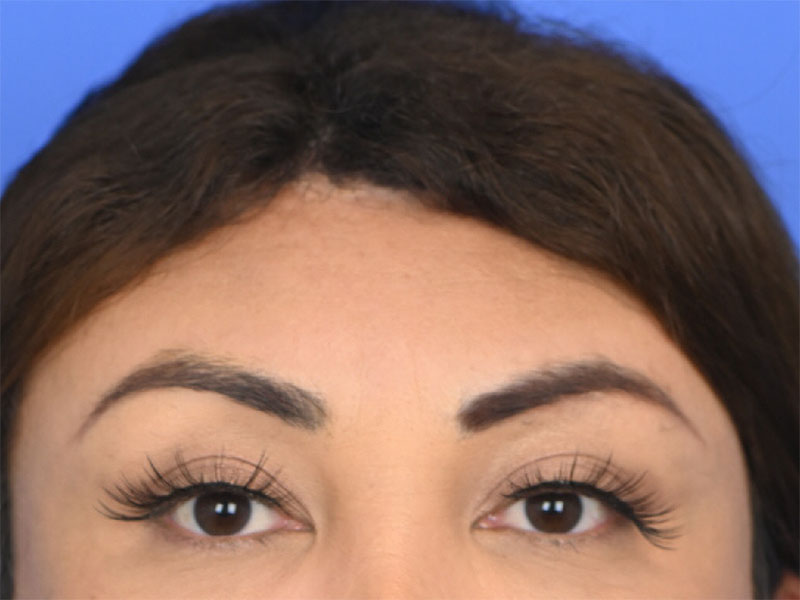 Brow Bossing Reduction Before & After Image