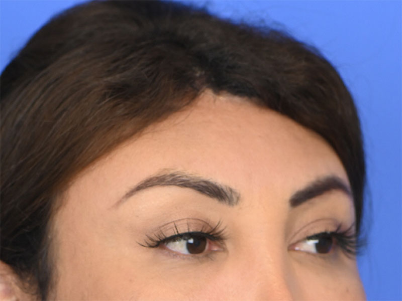 Brow Bossing Reduction Before & After Image