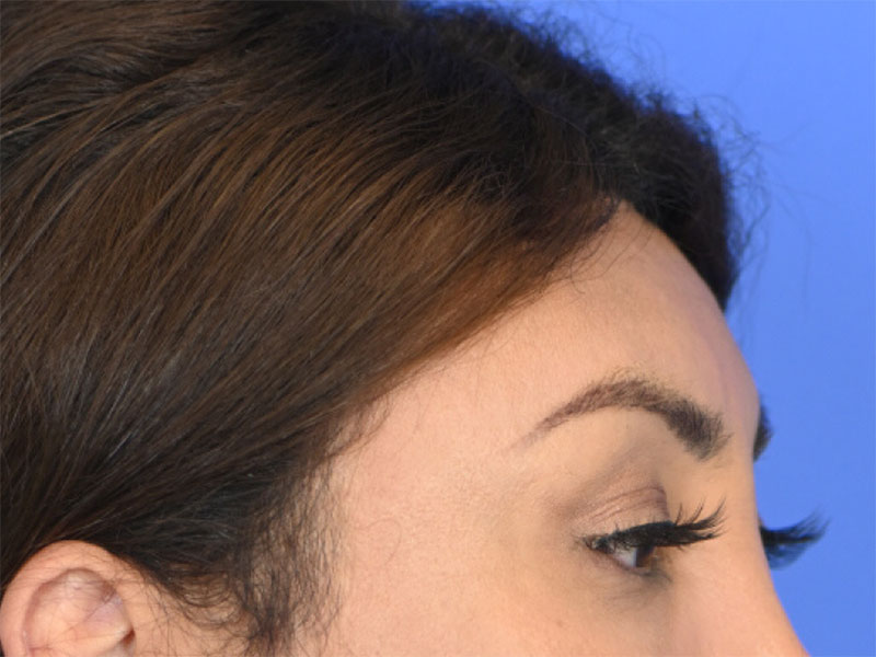 Brow Bossing Reduction Before & After Image