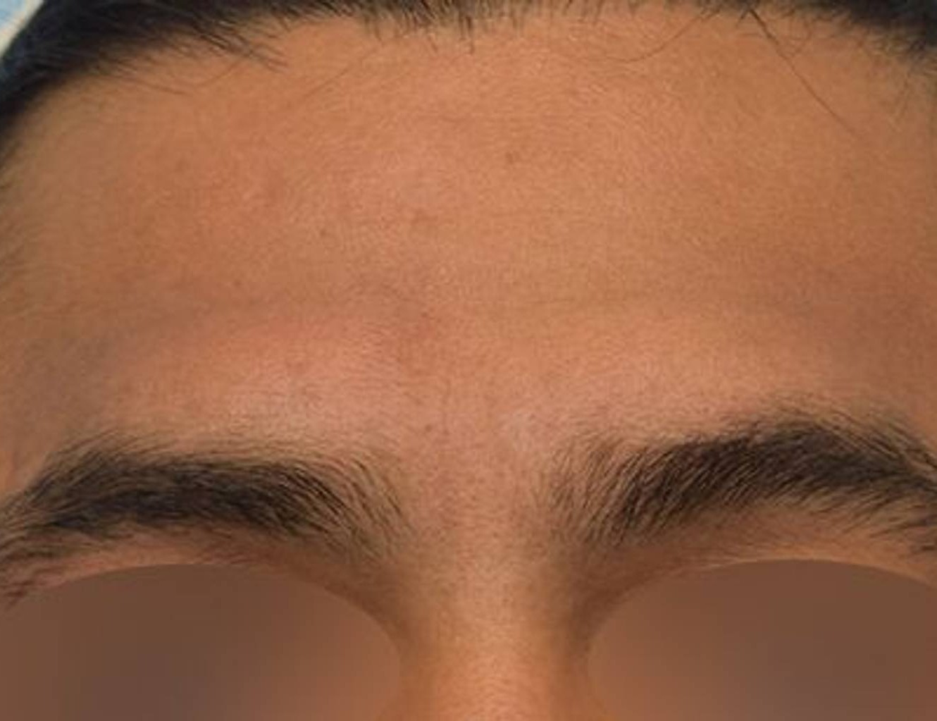 Brow Bossing Reduction Before & After Image