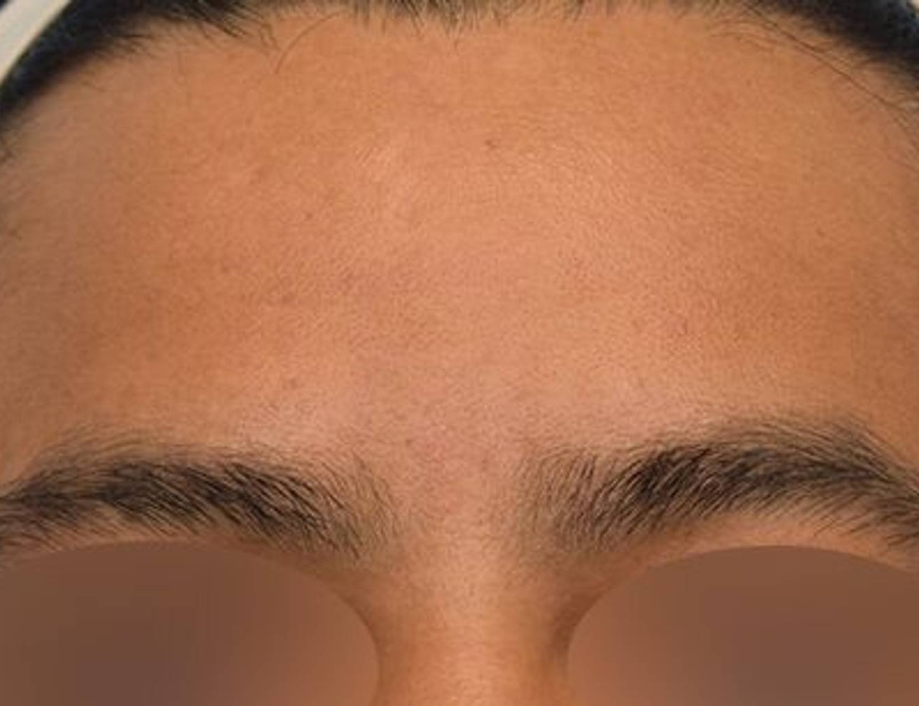 Brow Bossing Reduction Before & After Image