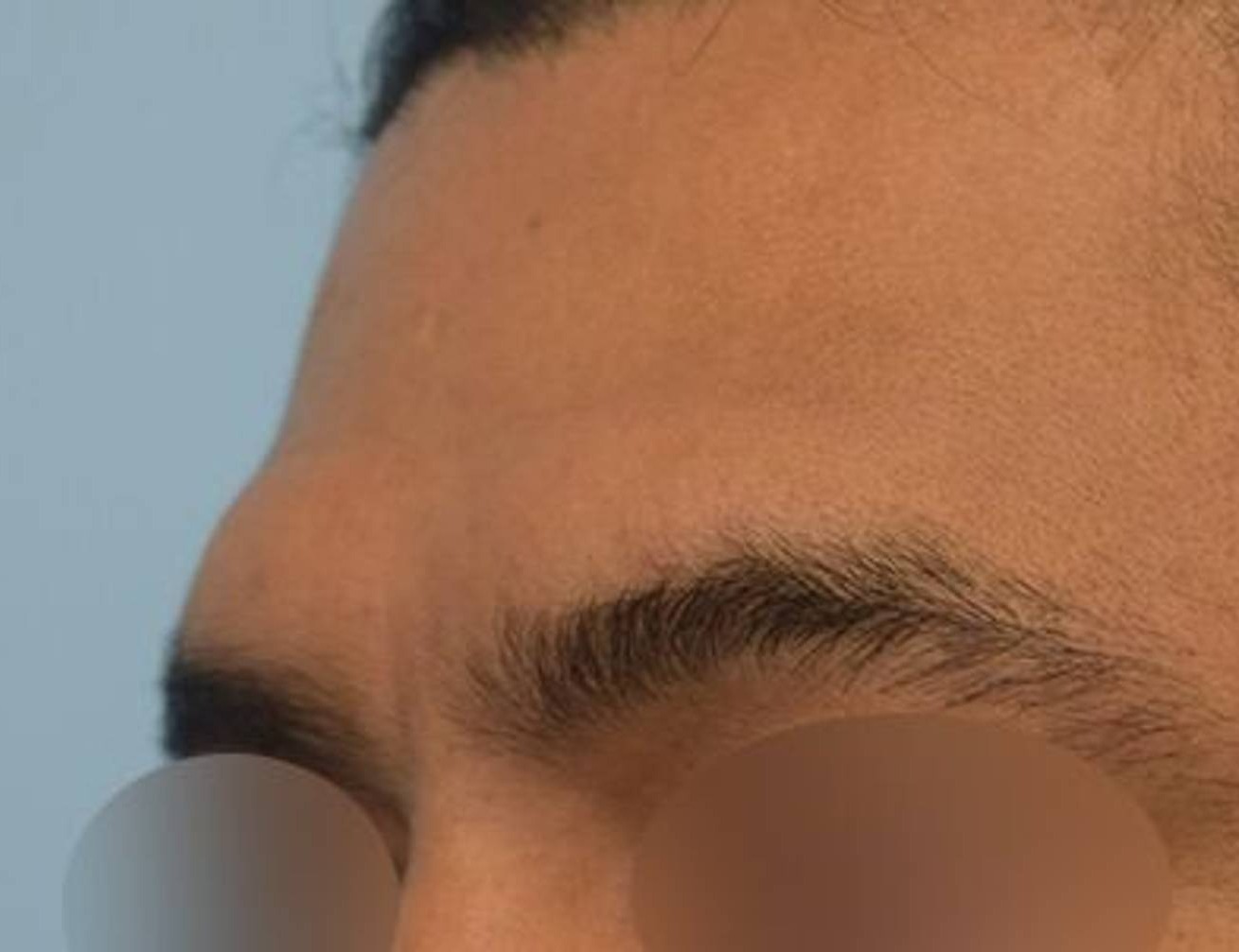 Brow Bossing Reduction Before & After Image