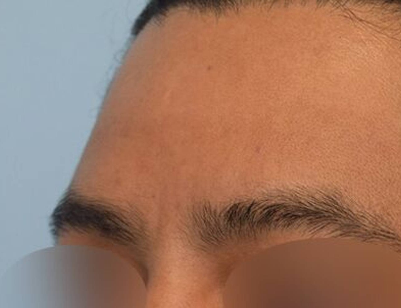 Brow Bossing Reduction Before & After Image