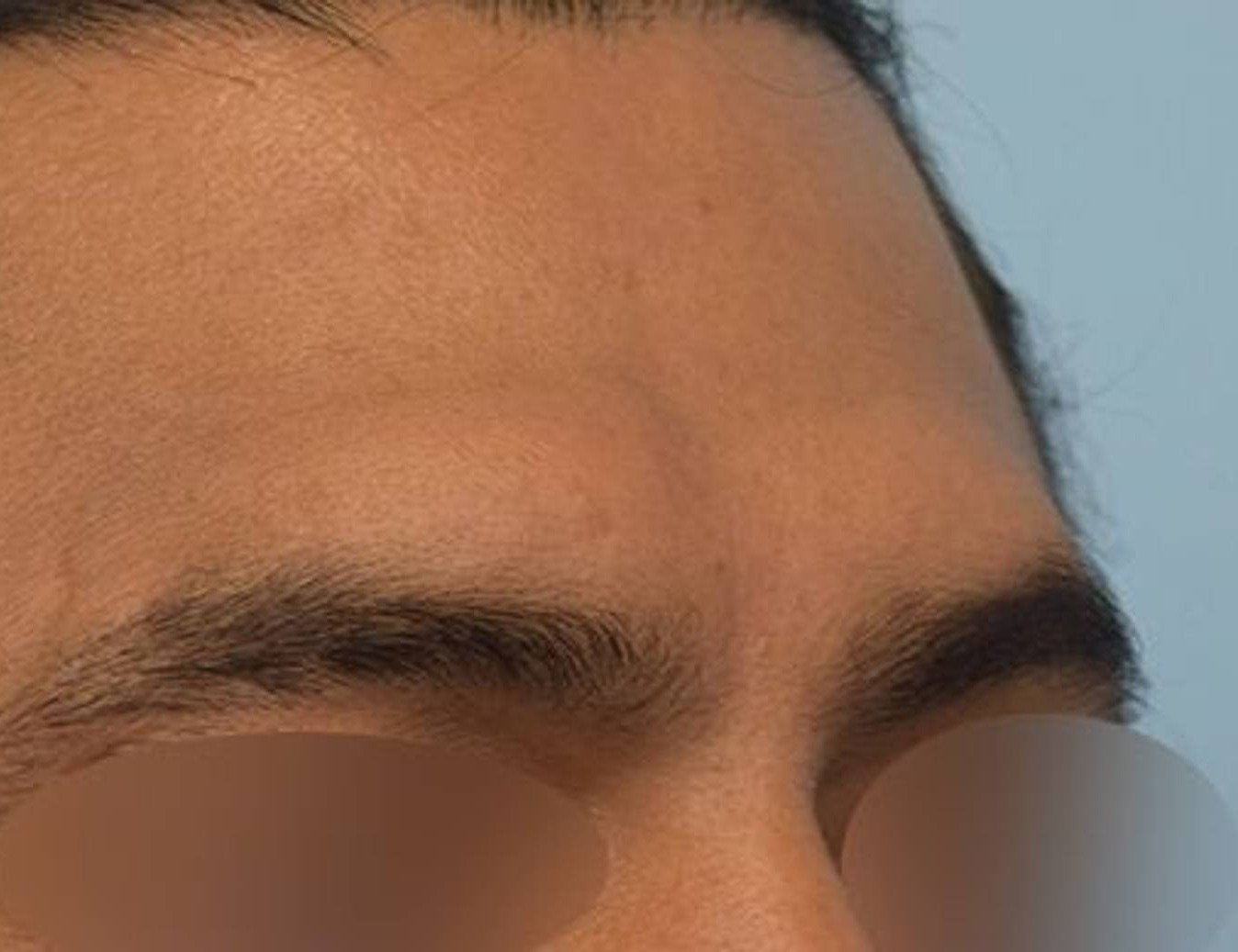 Brow Bossing Reduction Before & After Image