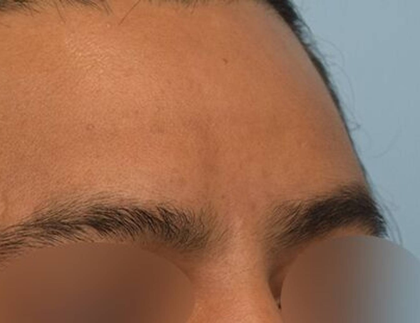 Brow Bossing Reduction Before & After Image