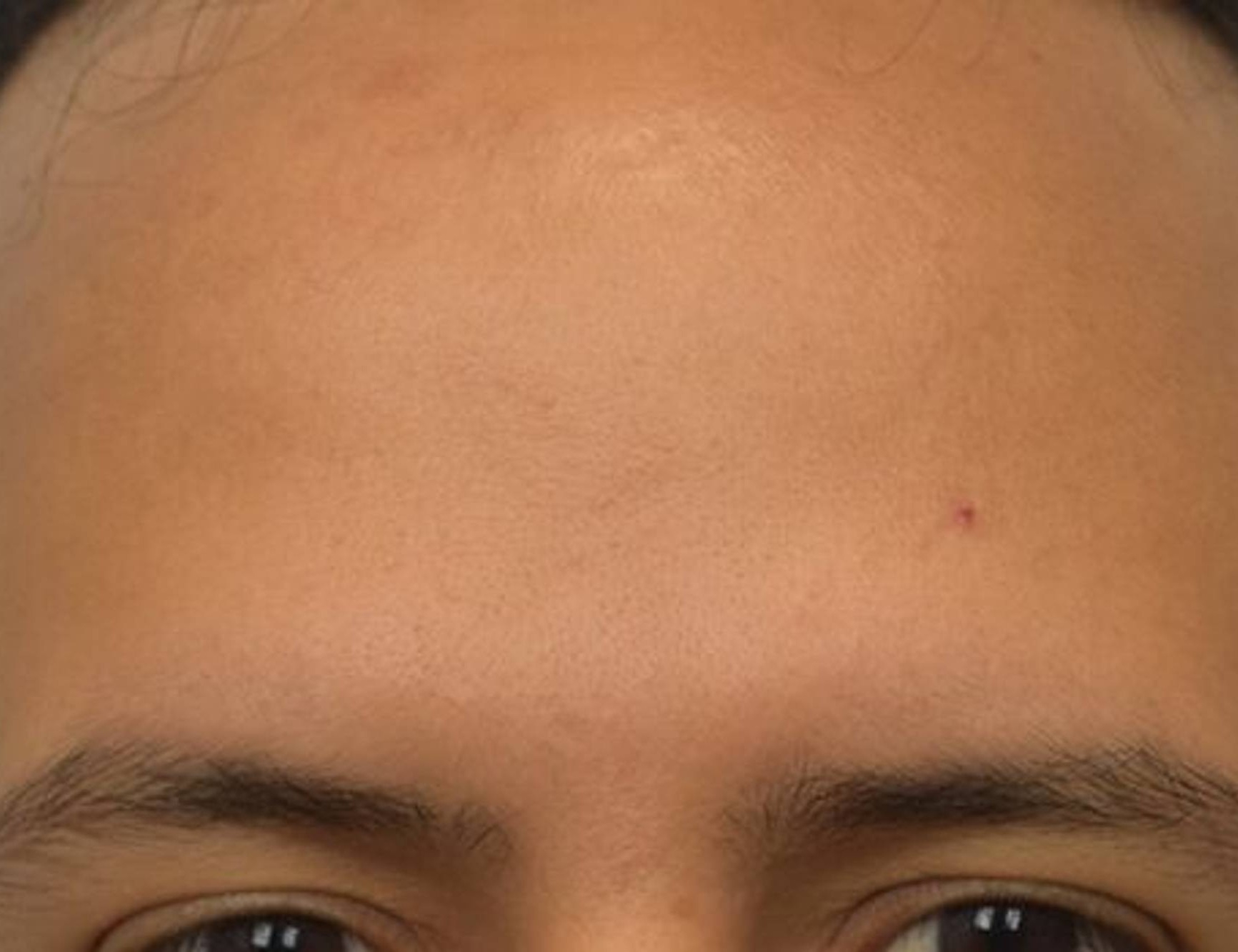 Brow Bossing Reduction Before & After Image