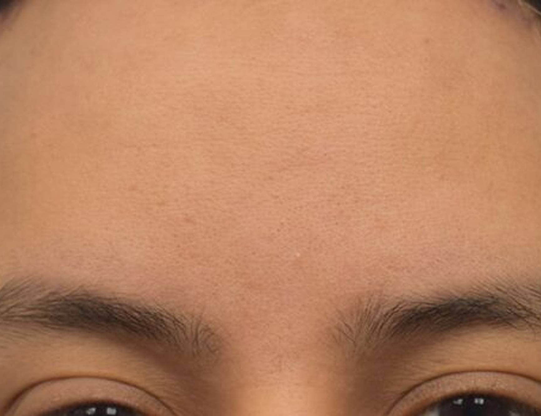 Brow Bossing Reduction Before & After Image