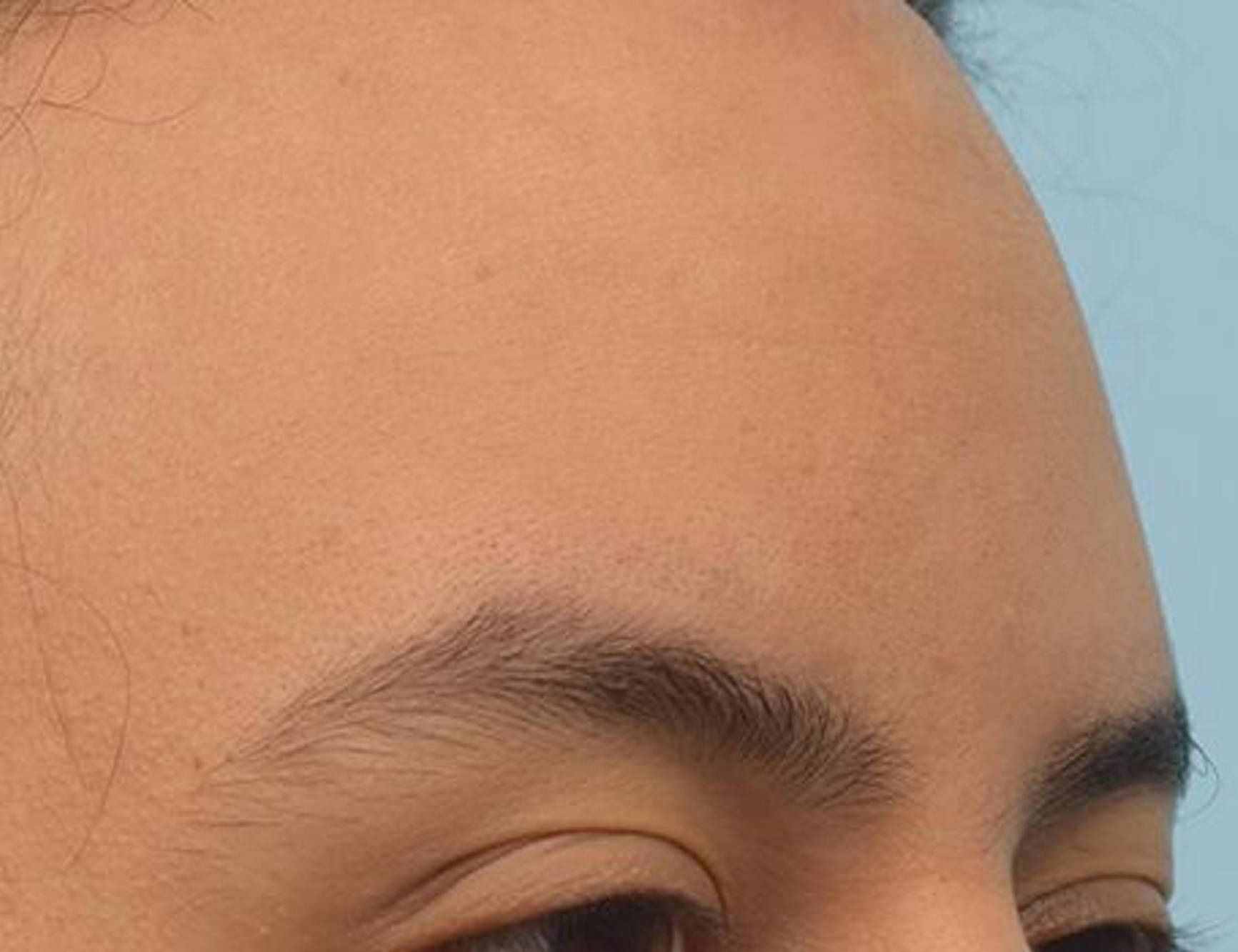 Brow Bossing Reduction Before & After Image