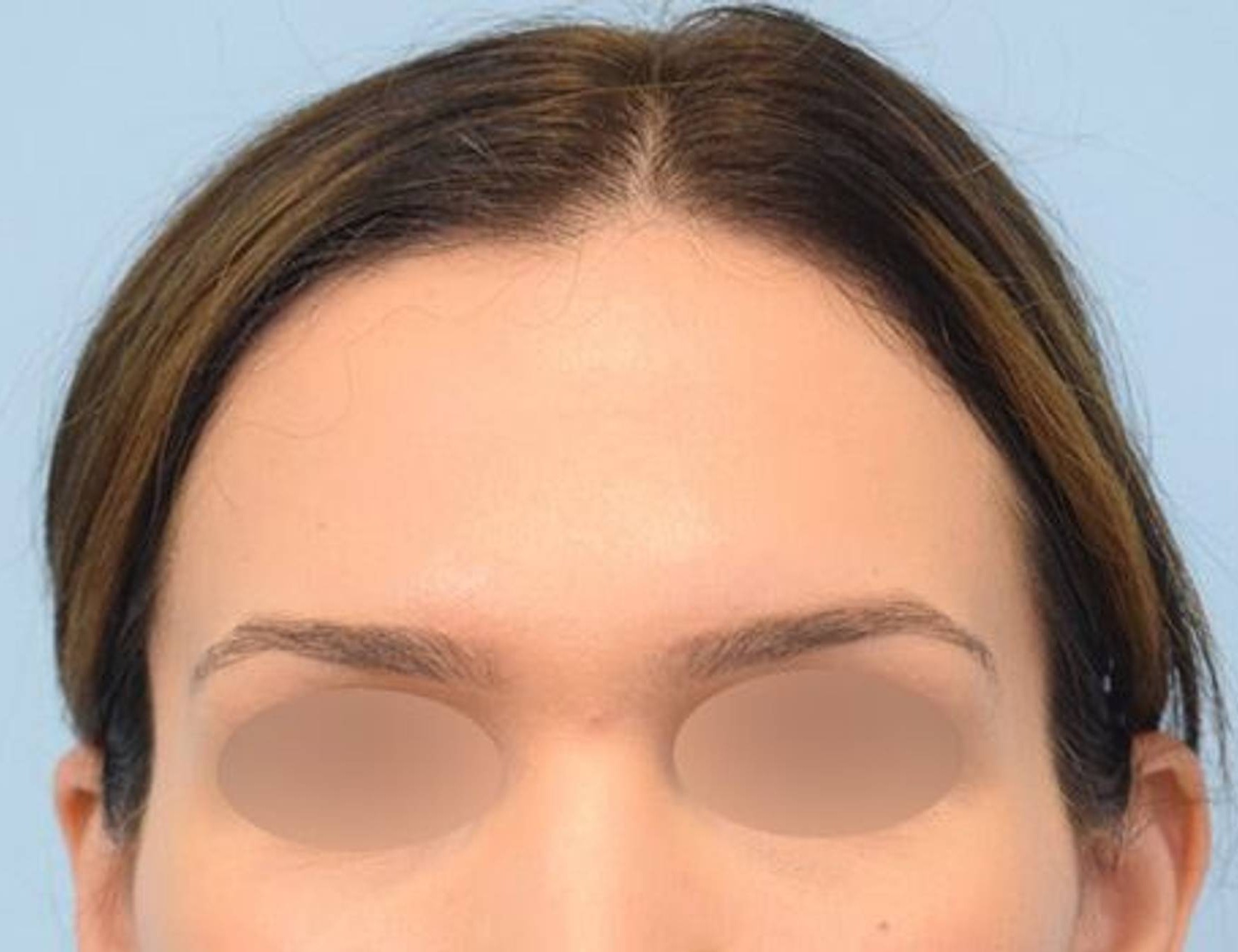 Brow Bossing Reduction Before & After Image