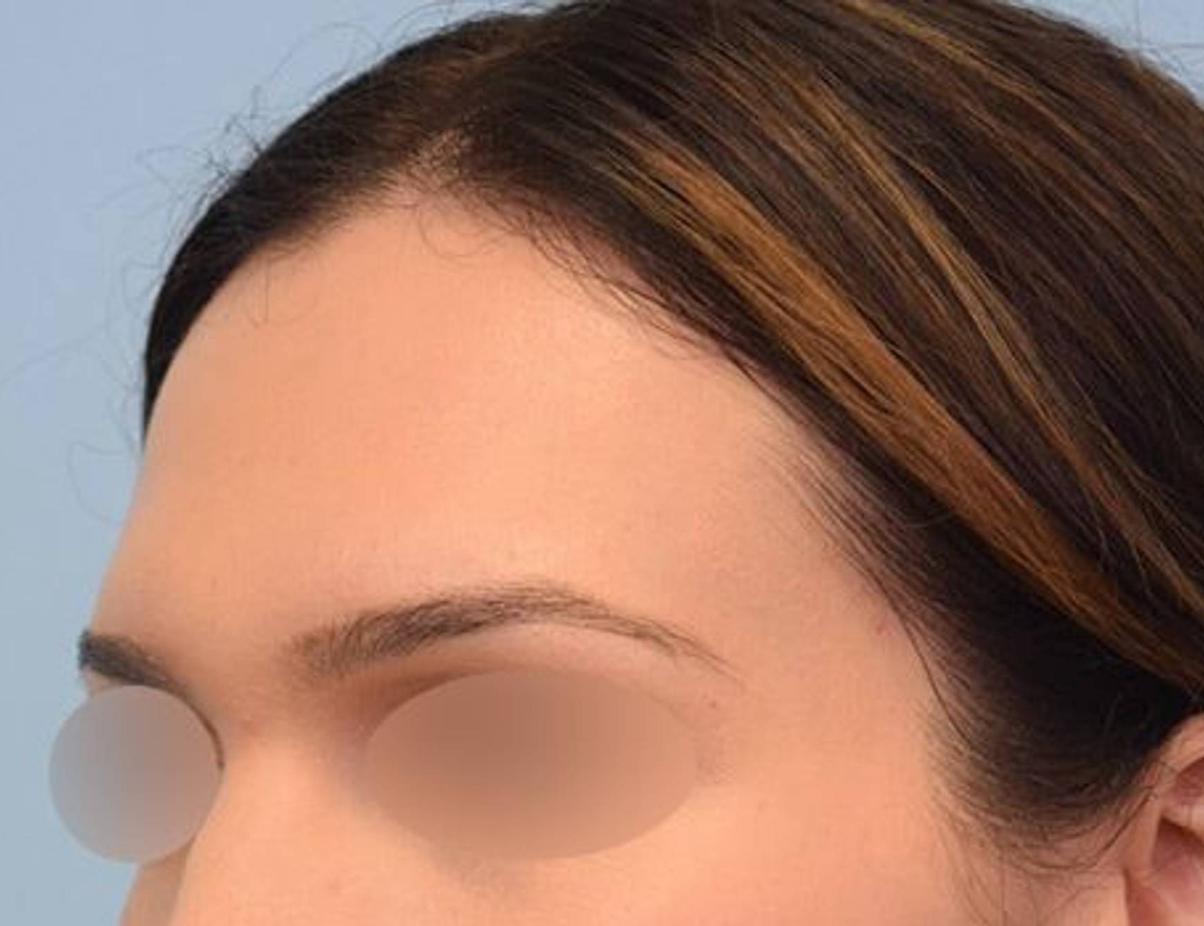 Brow Bossing Reduction Before & After Image