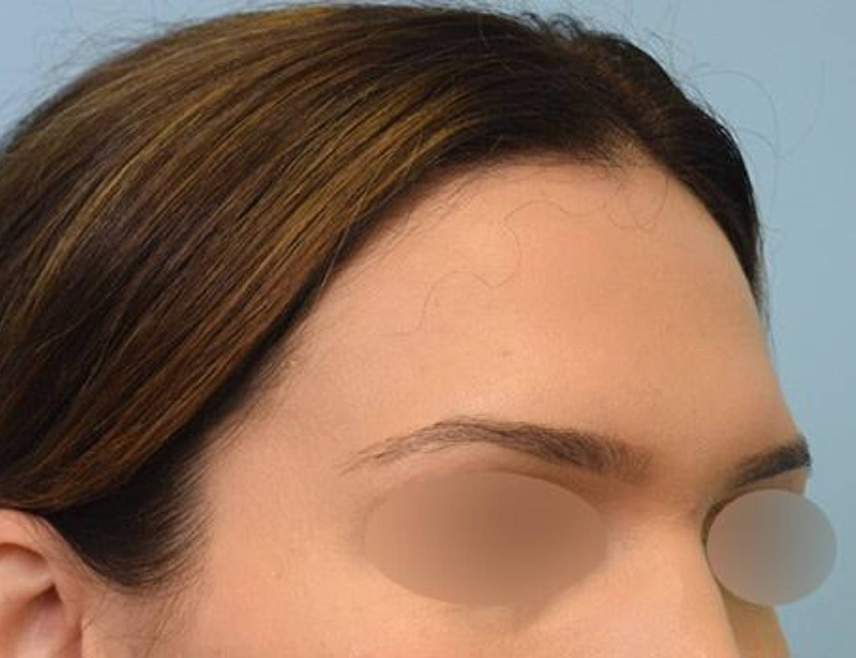 Brow Bossing Reduction Before & After Image