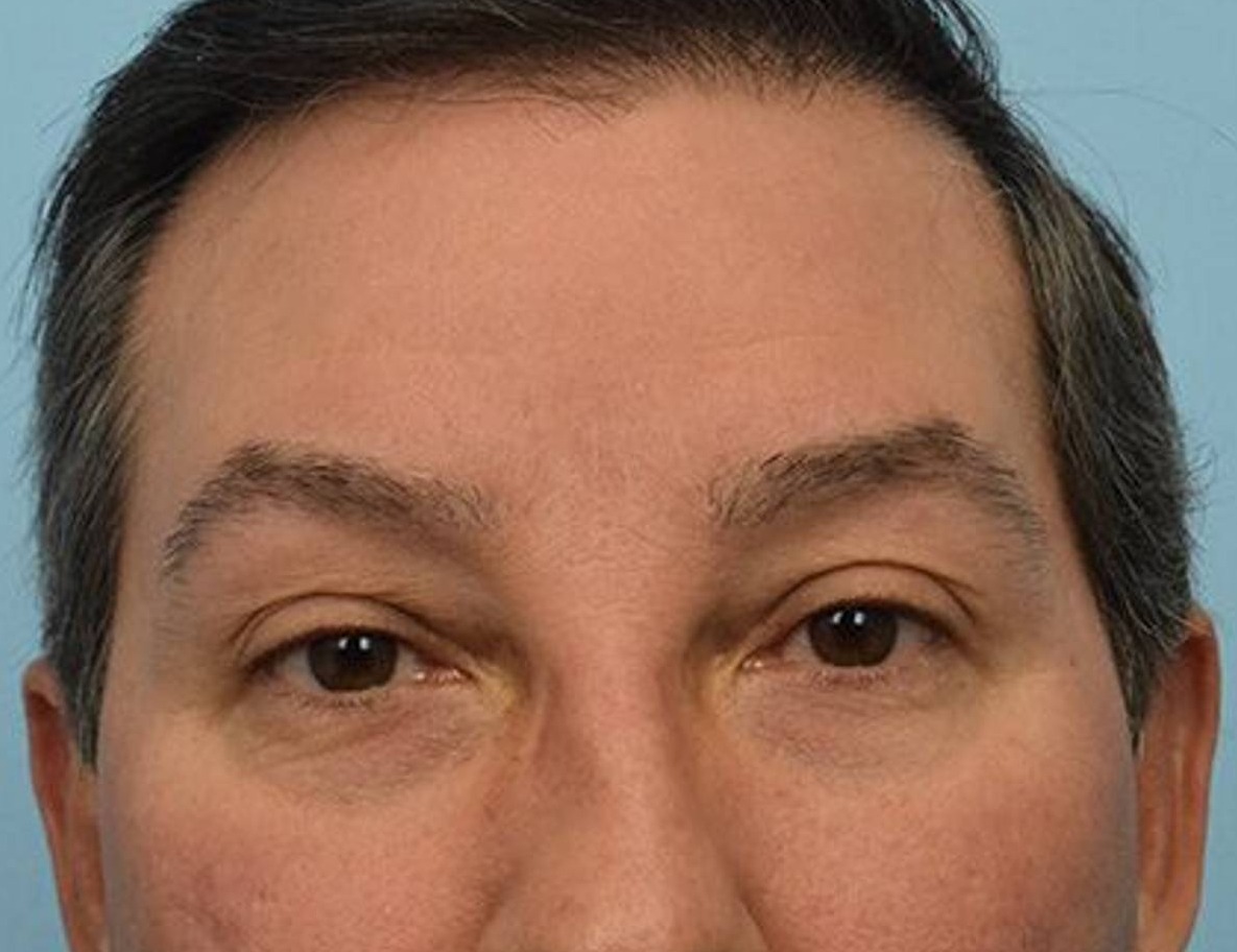 Brow Bossing Reduction Before & After Image