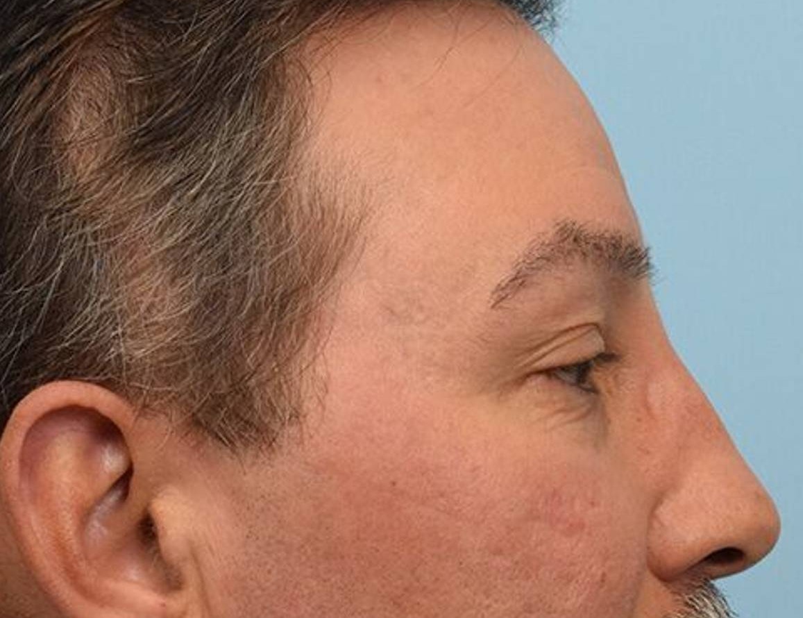 Brow Bossing Reduction Before & After Image