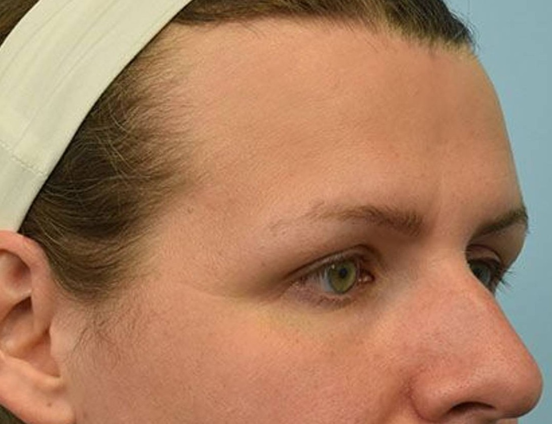 Brow Bossing Reduction Before & After Image