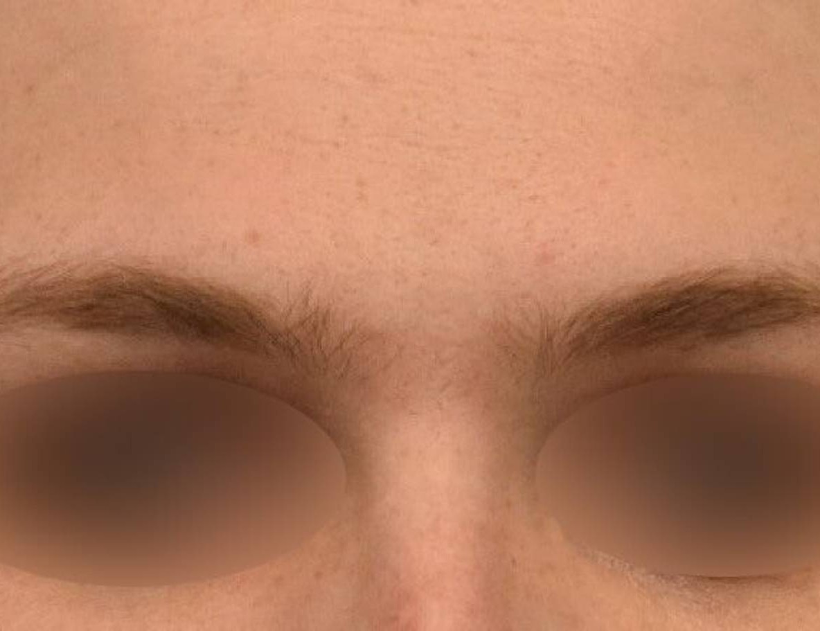 Brow Bossing Reduction Before & After Image